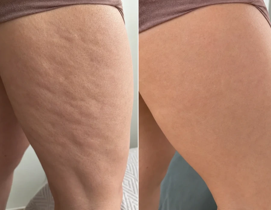 Before and after legs cellulite reduction closeup