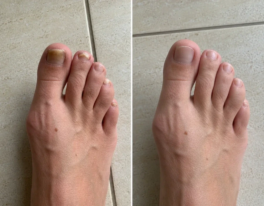 Before and after toenail fungus treatment foot