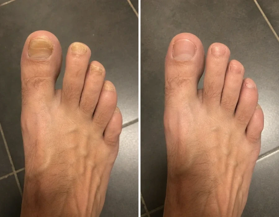 Before and after toenail fungus treatment foot